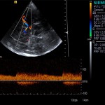 eco-doppler-transcraneal