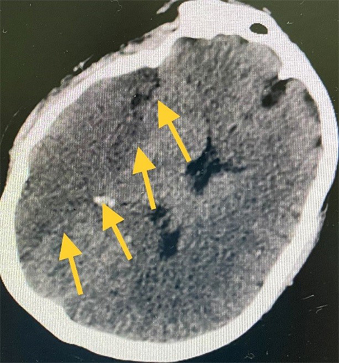 Foto de ataque cerebrovascular