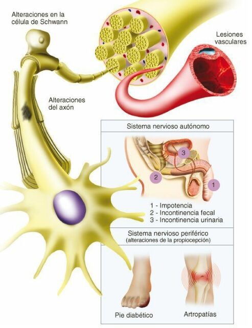 neuropatía periférica